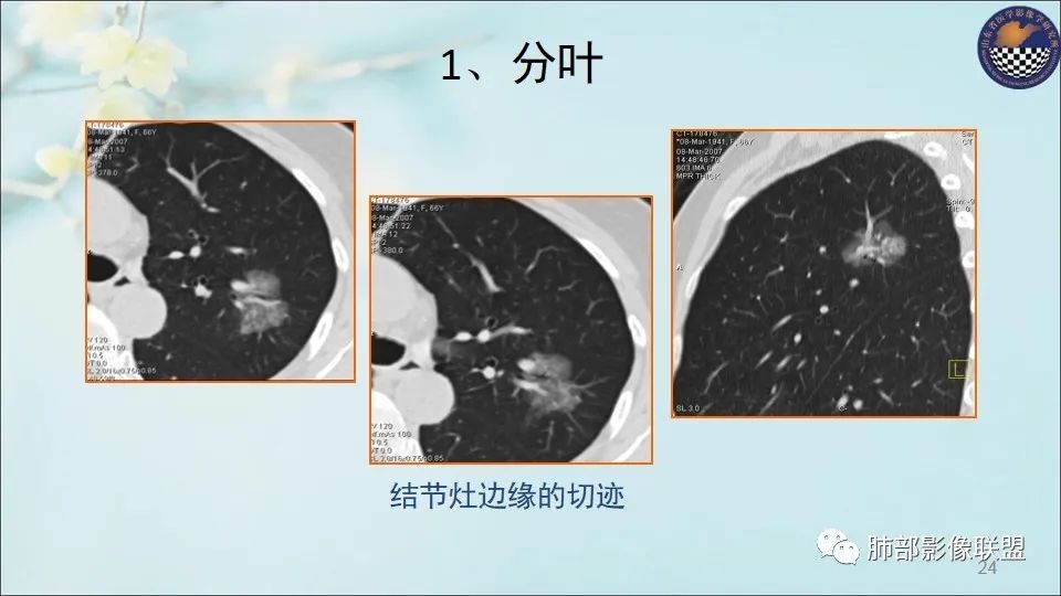 【PPT】重视针对肺GGO的战略转移
