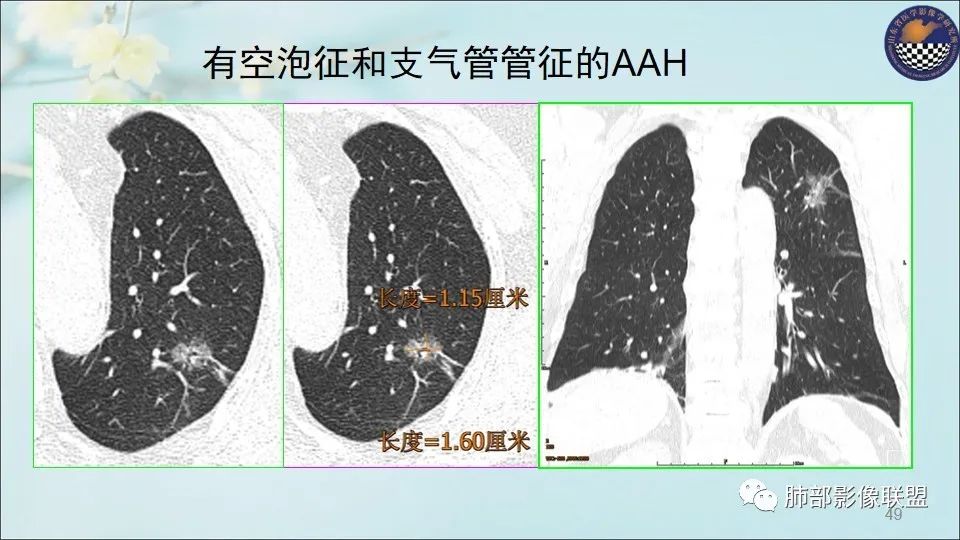【PPT】重视针对肺GGO的战略转移