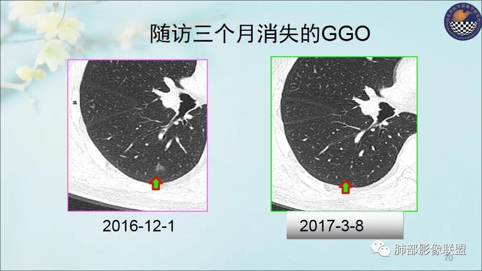 【PPT】重视针对肺GGO的战略转移