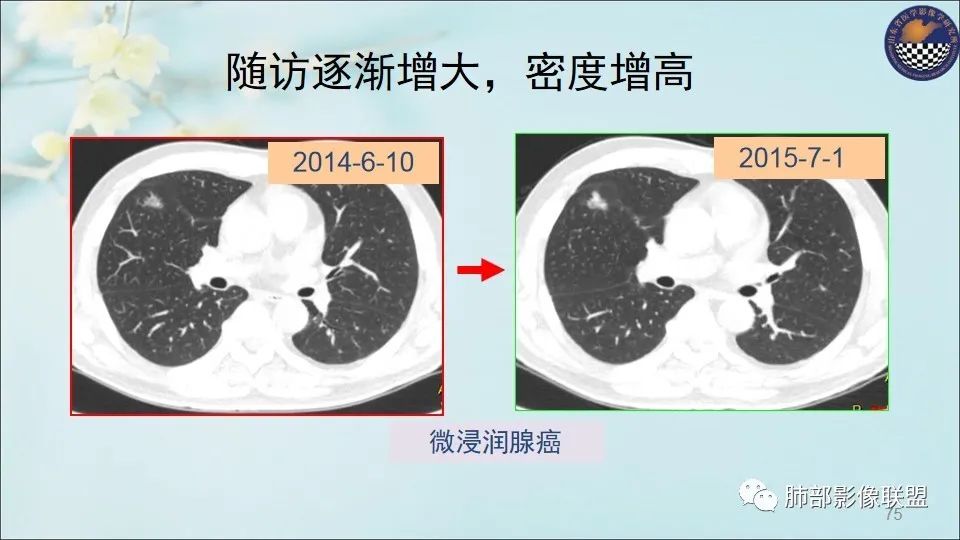 【PPT】重视针对肺GGO的战略转移