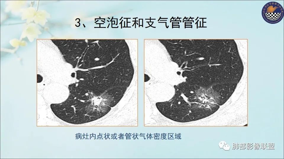 【PPT】重视针对肺GGO的战略转移