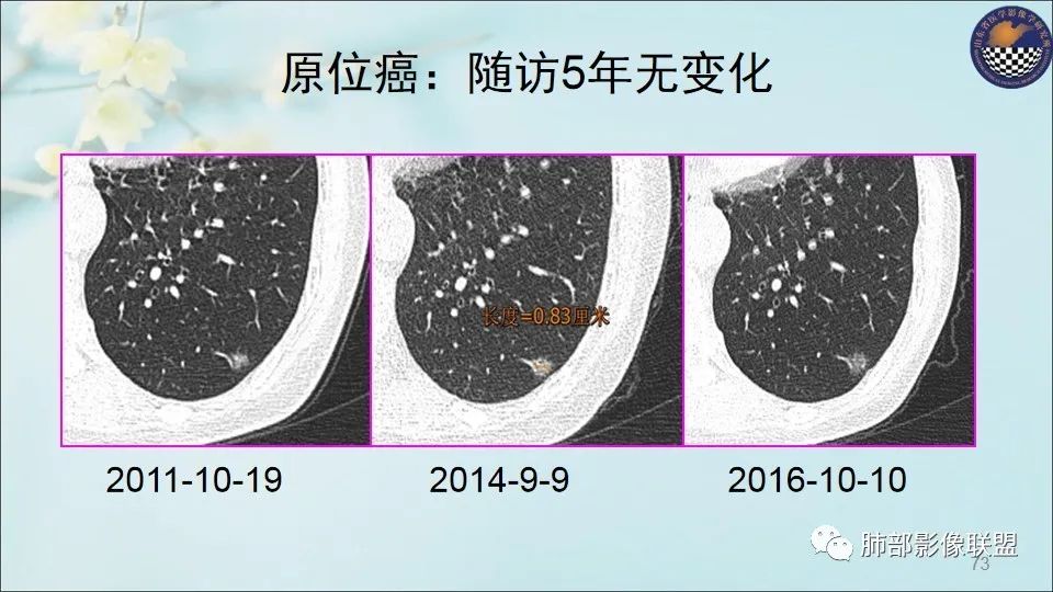 【PPT】重视针对肺GGO的战略转移