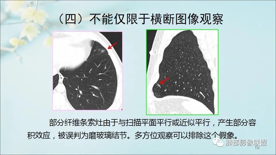 【PPT】重视针对肺GGO的战略转移