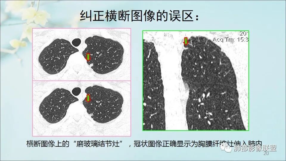 【PPT】重视针对肺GGO的战略转移