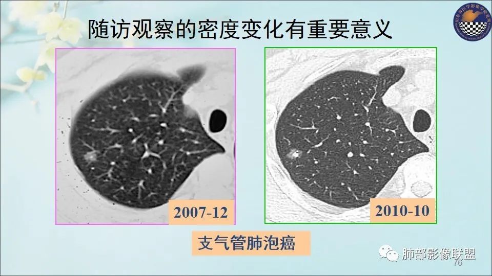 【PPT】重视针对肺GGO的战略转移
