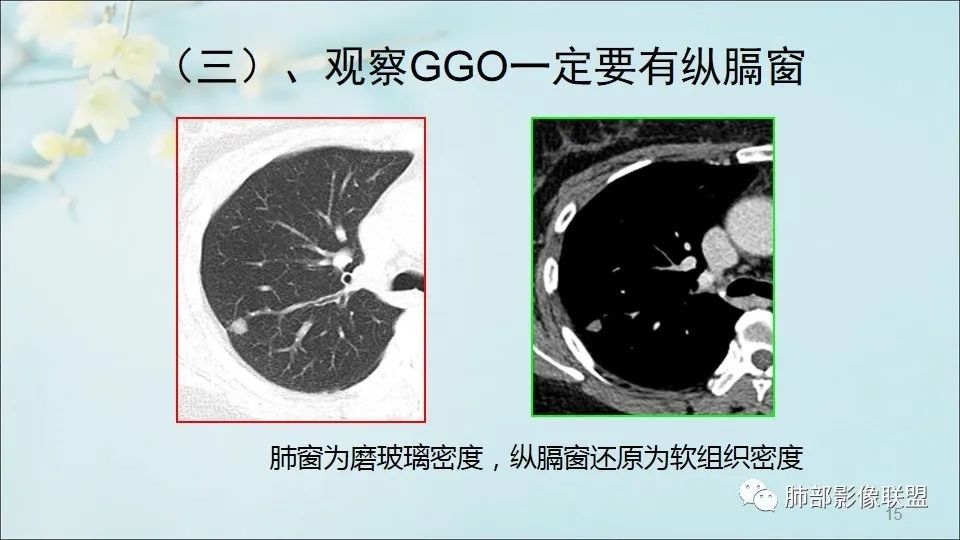 【PPT】重视针对肺GGO的战略转移