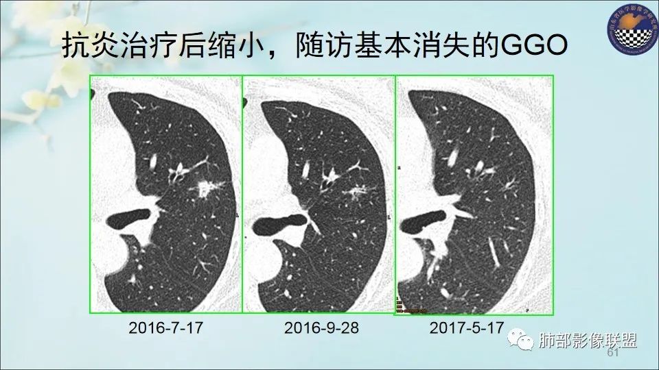 【PPT】重视针对肺GGO的战略转移