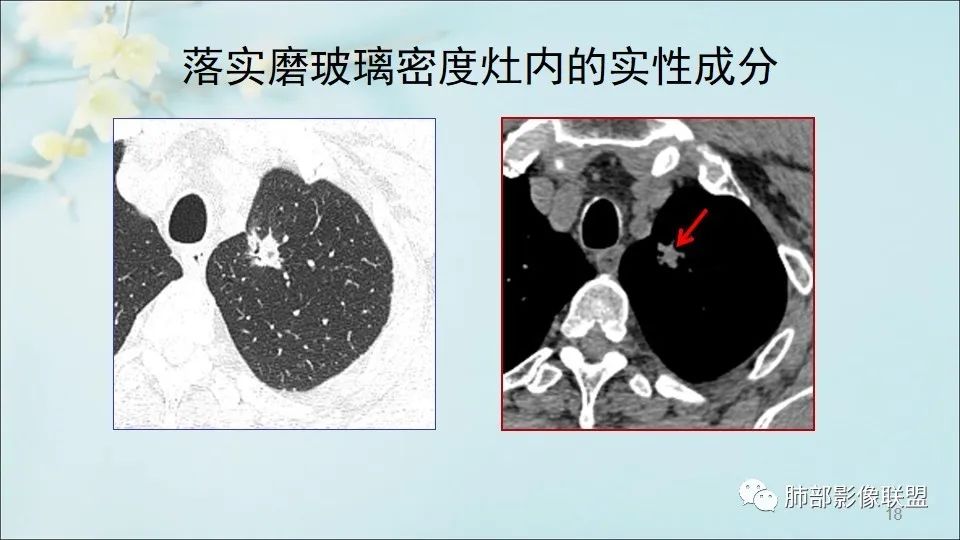 【PPT】重视针对肺GGO的战略转移