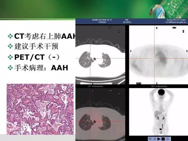 【PPT】肺磨玻璃密度阴影(GGO) 的CT诊断与处理