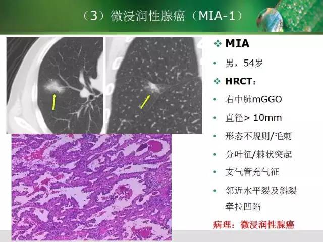 【PPT】肺磨玻璃密度阴影(GGO) 的CT诊断与处理