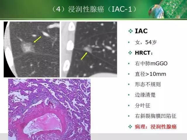 【PPT】肺磨玻璃密度阴影(GGO) 的CT诊断与处理