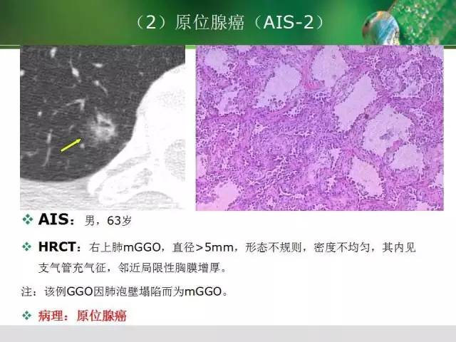 【PPT】肺磨玻璃密度阴影(GGO) 的CT诊断与处理