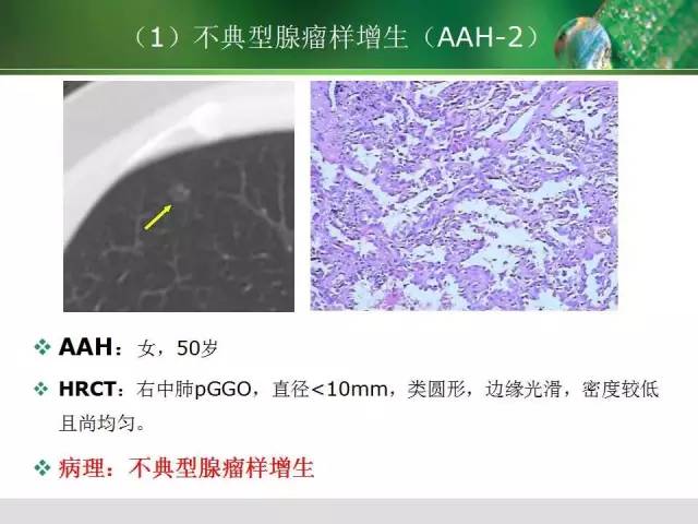 【PPT】肺磨玻璃密度阴影(GGO) 的CT诊断与处理