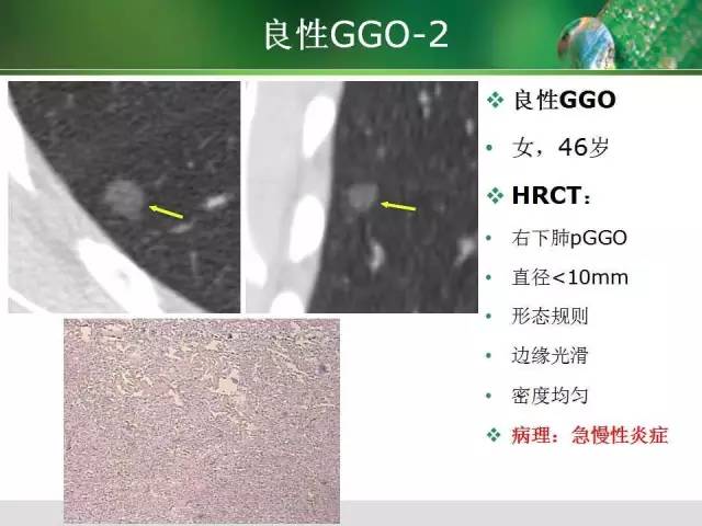 【PPT】肺磨玻璃密度阴影(GGO) 的CT诊断与处理