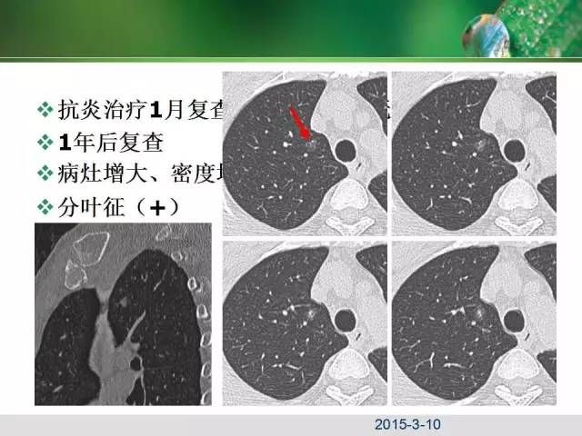 【PPT】肺磨玻璃密度阴影(GGO) 的CT诊断与处理