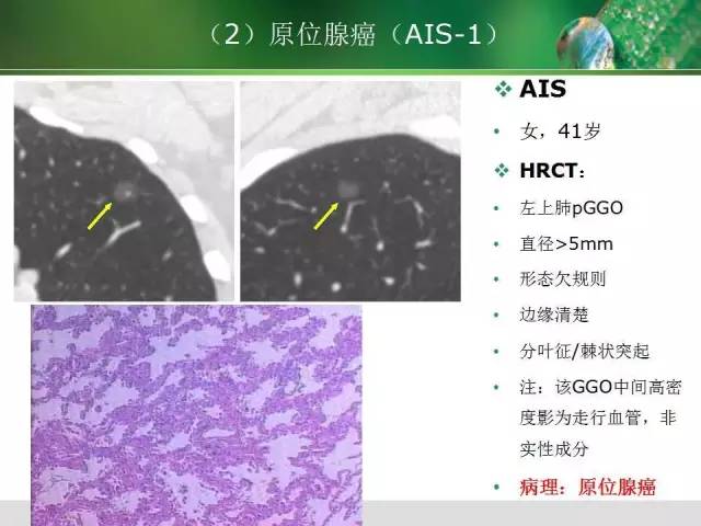 【PPT】肺磨玻璃密度阴影(GGO) 的CT诊断与处理