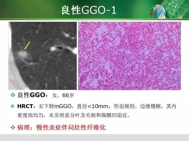【PPT】肺磨玻璃密度阴影(GGO) 的CT诊断与处理