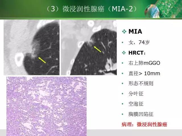 【PPT】肺磨玻璃密度阴影(GGO) 的CT诊断与处理