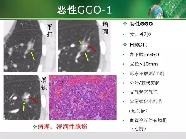 【PPT】肺磨玻璃密度阴影(GGO) 的CT诊断与处理