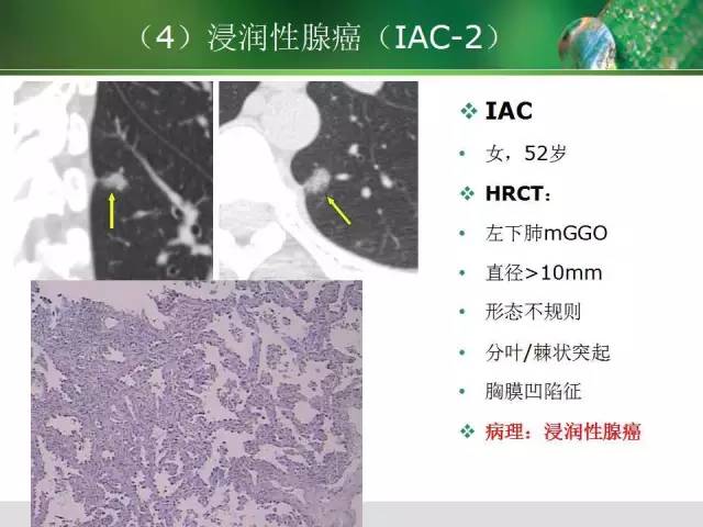 【PPT】肺磨玻璃密度阴影(GGO) 的CT诊断与处理
