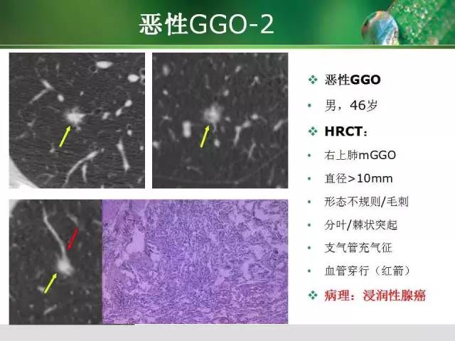 【PPT】肺磨玻璃密度阴影(GGO) 的CT诊断与处理