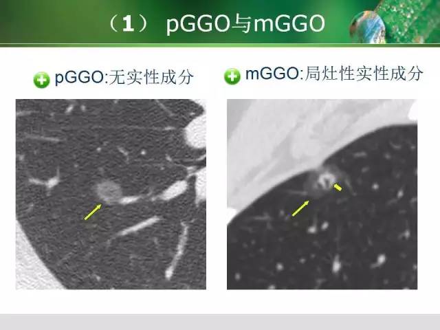 肺磨玻璃密度阴影GGO 的CT诊断与处理