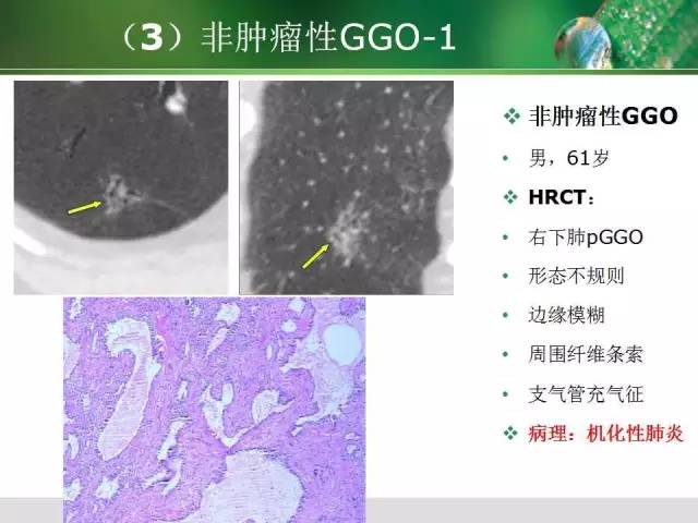 【PPT】肺磨玻璃密度阴影(GGO) 的CT诊断与处理