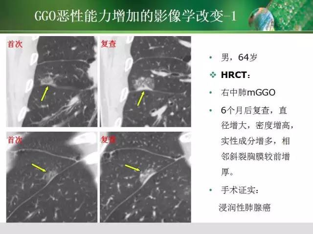 【PPT】肺磨玻璃密度阴影(GGO) 的CT诊断与处理