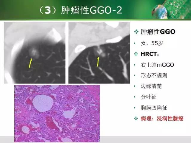 【PPT】肺磨玻璃密度阴影(GGO) 的CT诊断与处理