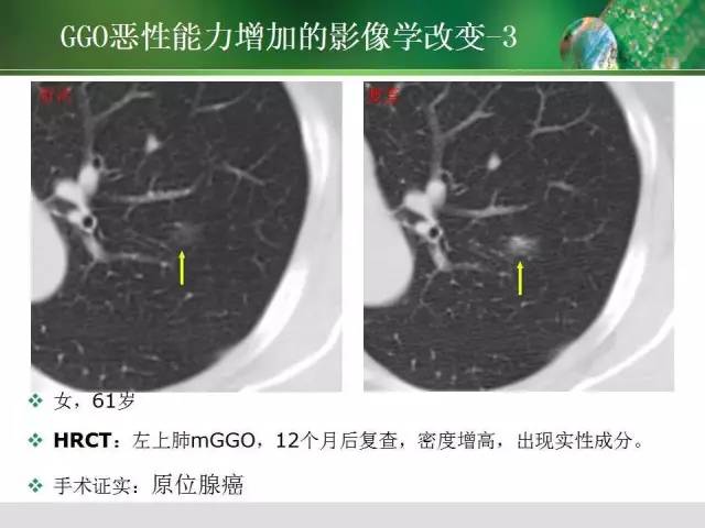 【PPT】肺磨玻璃密度阴影(GGO) 的CT诊断与处理