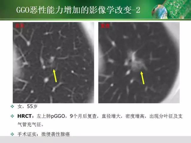 【PPT】肺磨玻璃密度阴影(GGO) 的CT诊断与处理