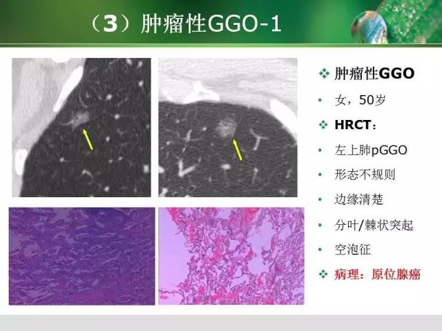【PPT】肺磨玻璃密度阴影(GGO) 的CT诊断与处理