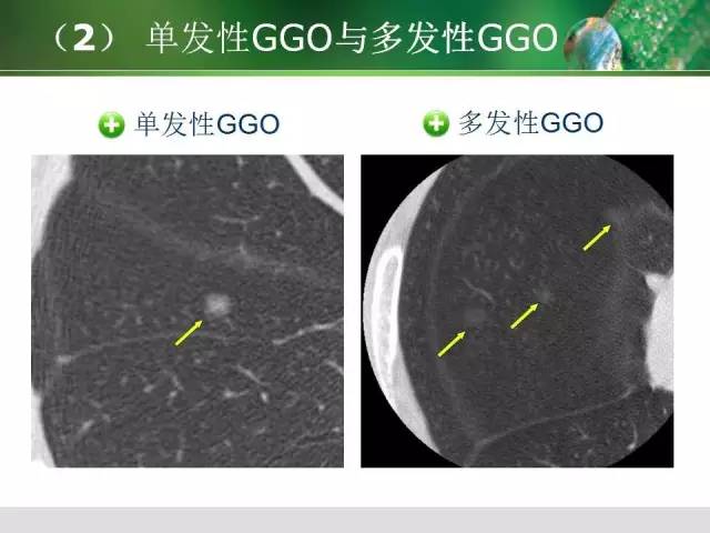 【PPT】肺磨玻璃密度阴影(GGO) 的CT诊断与处理
