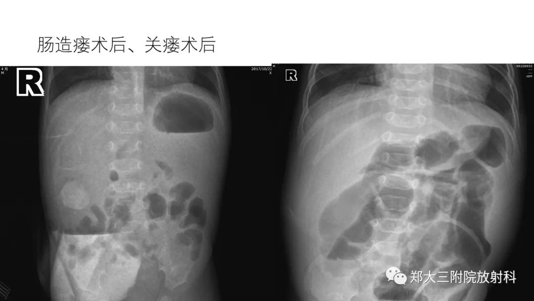 【PPT】新生儿坏死性小肠结肠炎 【PPT】新生儿坏死性小肠结肠炎
