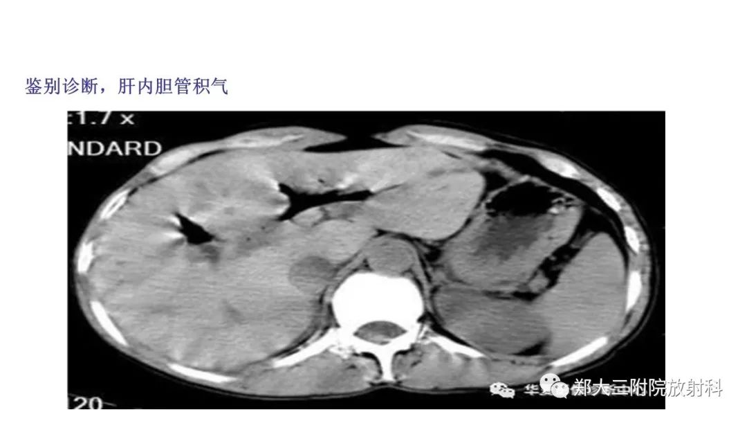 【PPT】新生儿坏死性小肠结肠炎 【PPT】新生儿坏死性小肠结肠炎