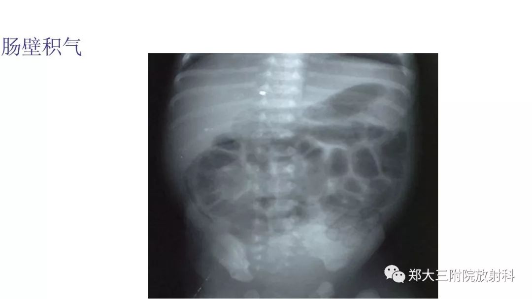 【PPT】新生儿坏死性小肠结肠炎 【PPT】新生儿坏死性小肠结肠炎