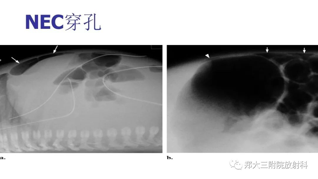 【PPT】新生儿坏死性小肠结肠炎 【PPT】新生儿坏死性小肠结肠炎