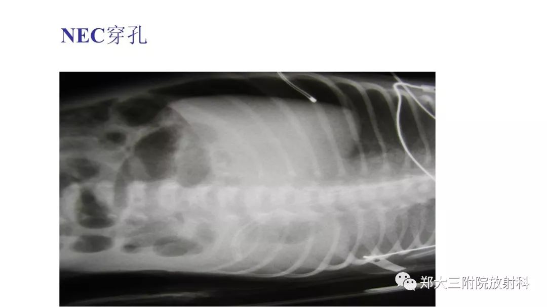 【PPT】新生儿坏死性小肠结肠炎 【PPT】新生儿坏死性小肠结肠炎