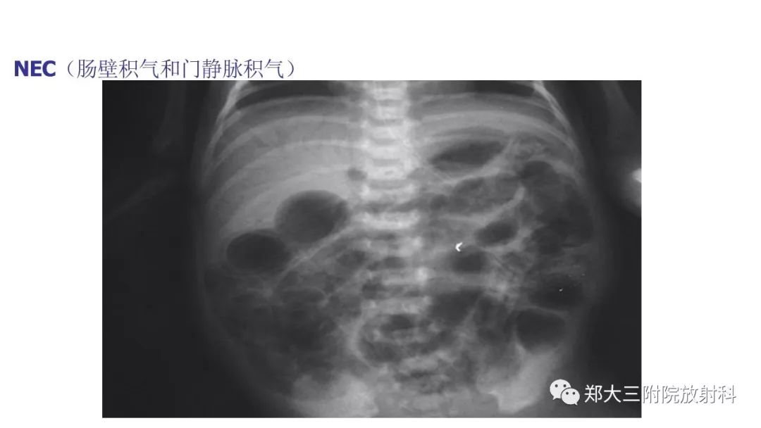 【PPT】新生儿坏死性小肠结肠炎 【PPT】新生儿坏死性小肠结肠炎