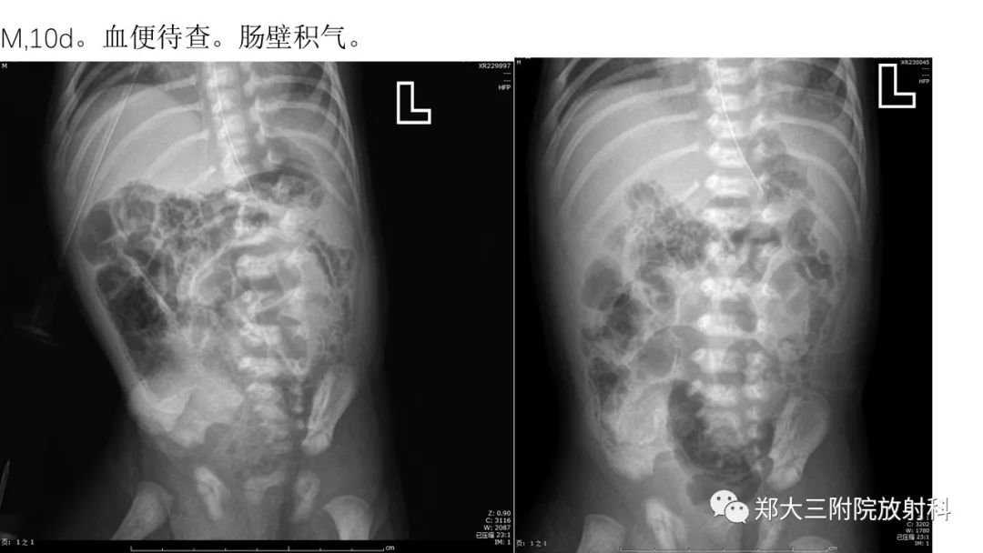 【PPT】新生儿坏死性小肠结肠炎 【PPT】新生儿坏死性小肠结肠炎