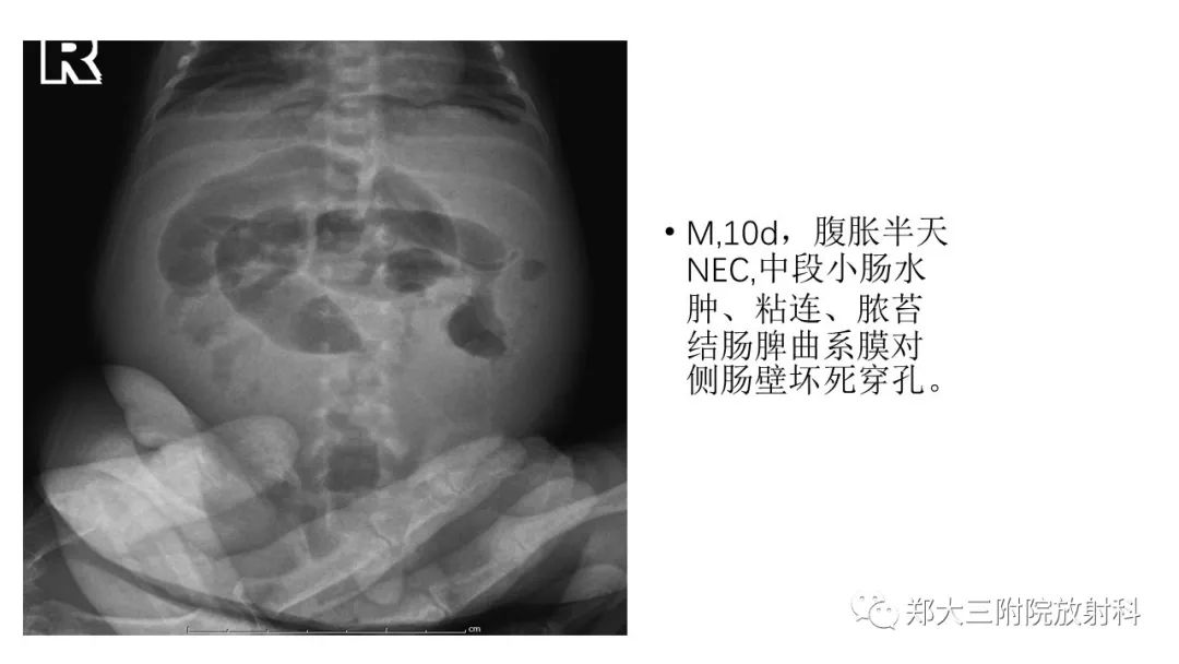 【PPT】新生儿坏死性小肠结肠炎 【PPT】新生儿坏死性小肠结肠炎