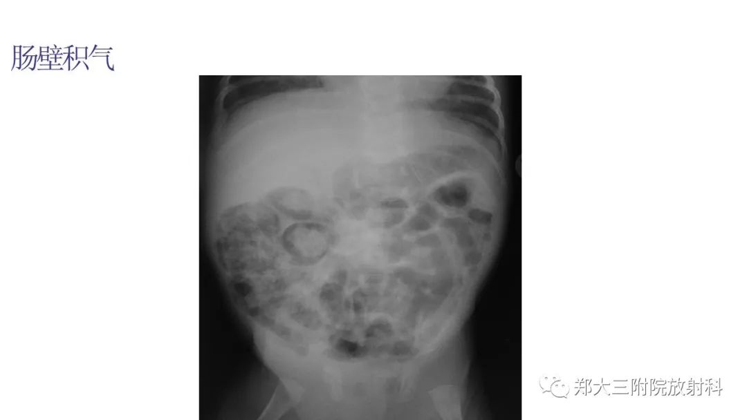 【PPT】新生儿坏死性小肠结肠炎 【PPT】新生儿坏死性小肠结肠炎