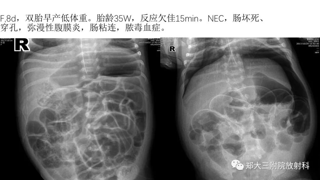 【PPT】新生儿坏死性小肠结肠炎 【PPT】新生儿坏死性小肠结肠炎