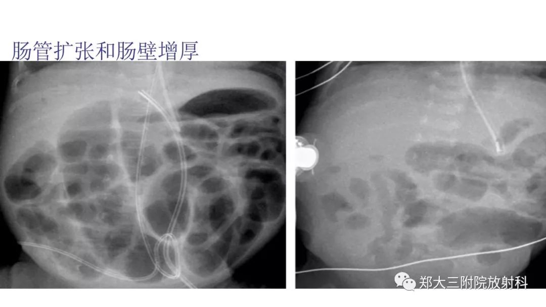 【PPT】新生儿坏死性小肠结肠炎 【PPT】新生儿坏死性小肠结肠炎