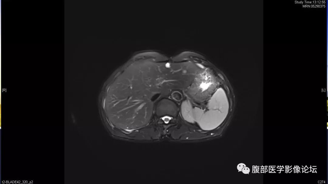 【病例】胰尾局灶性慢性胰腺炎1例MR影像讨论