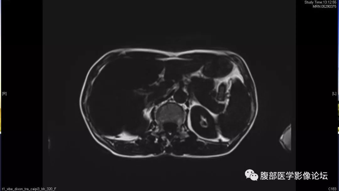 【病例】胰尾局灶性慢性胰腺炎1例MR影像讨论