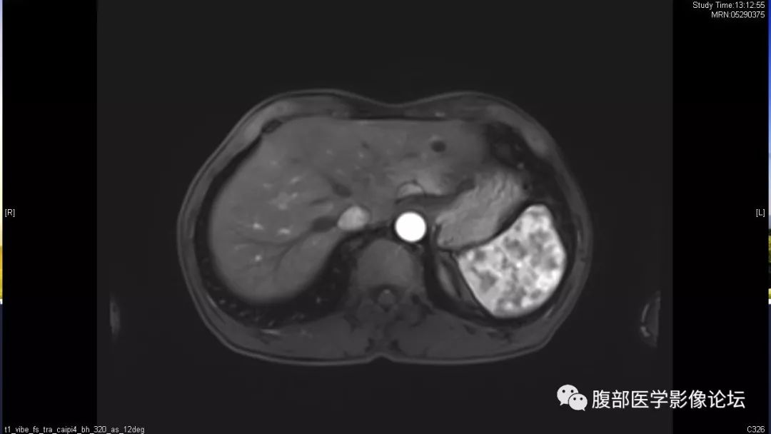【病例】胰尾局灶性慢性胰腺炎1例MR影像讨论