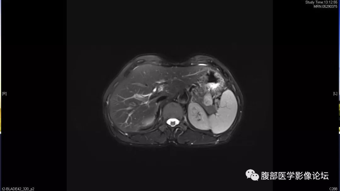【病例】胰尾局灶性慢性胰腺炎1例MR影像讨论
