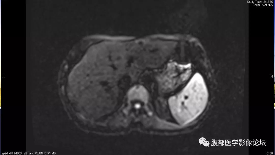 【病例】胰尾局灶性慢性胰腺炎1例MR影像讨论