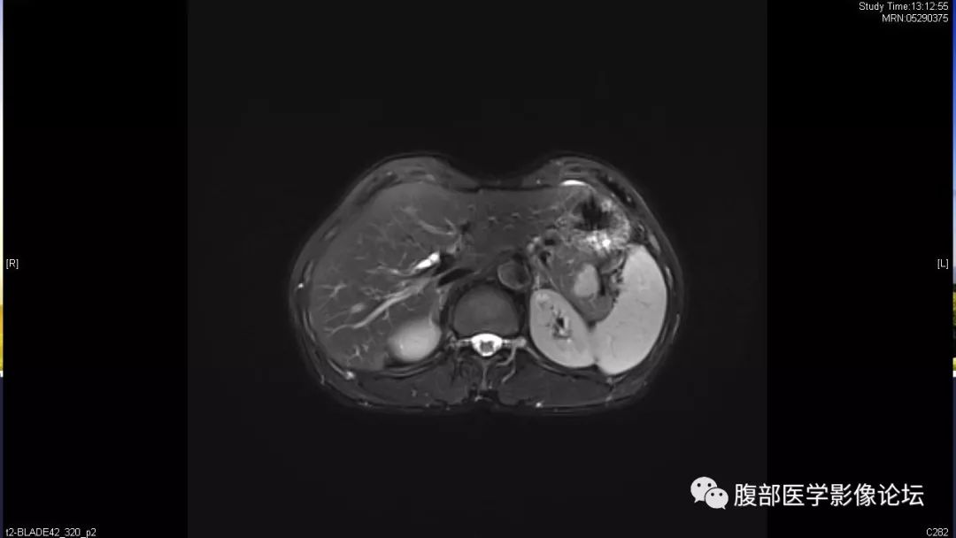 【病例】胰尾局灶性慢性胰腺炎1例MR影像讨论